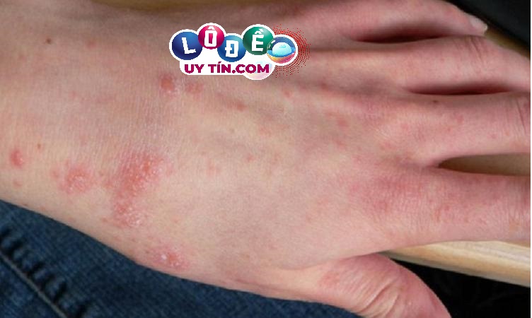 Nằm mơ thấy bị ghẻ lở là điềm gì? Đánh số nào? 1 Nằm mơ thấy bị ghẻ lở là điềm gì? Đánh số nào?