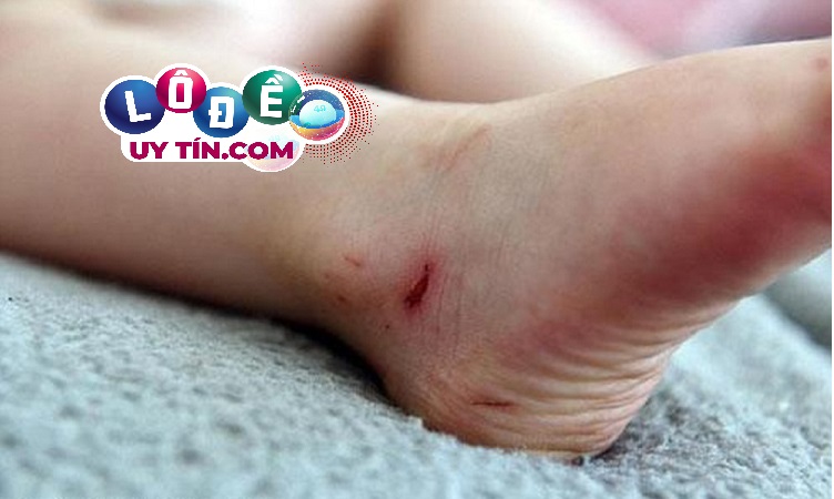 Điềm báo mơ thấy chảy máu chân đánh con gì? Có ý nghĩa gì? 4 Điềm báo mơ thấy chảy máu chân đánh con gì khi chạy nhanh