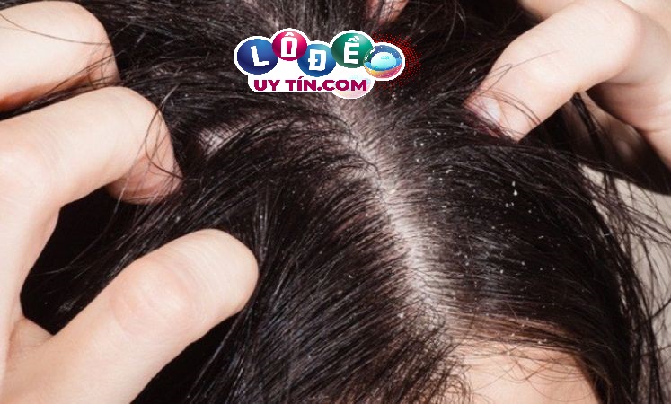 Giải mã giấc mơ thấy đầu có chấy - Số nào may mắn 2